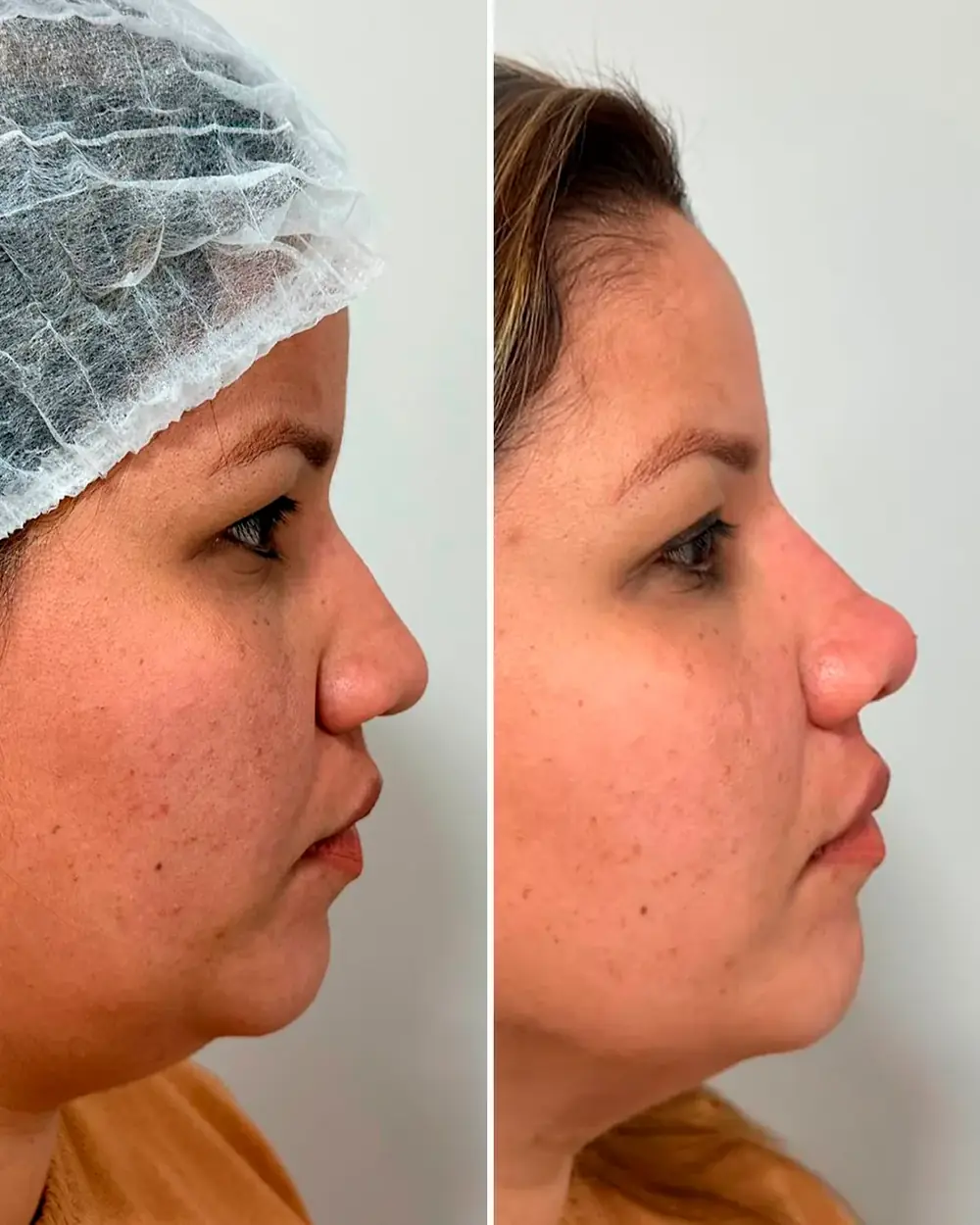 Antes e depois: Rinomodelação sem cirurgia