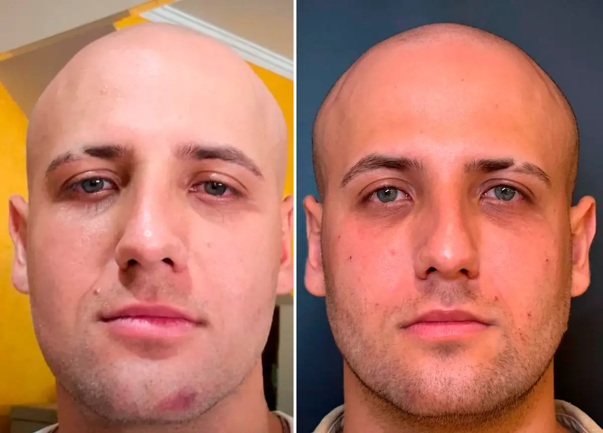 Antes e depois de harmonização facial com o Dr. Flávio Werneque