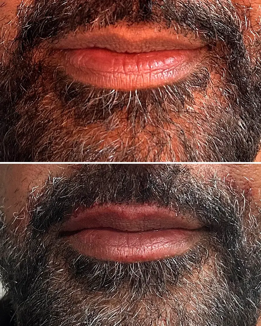 Antes e depois: Preenchimento labial
