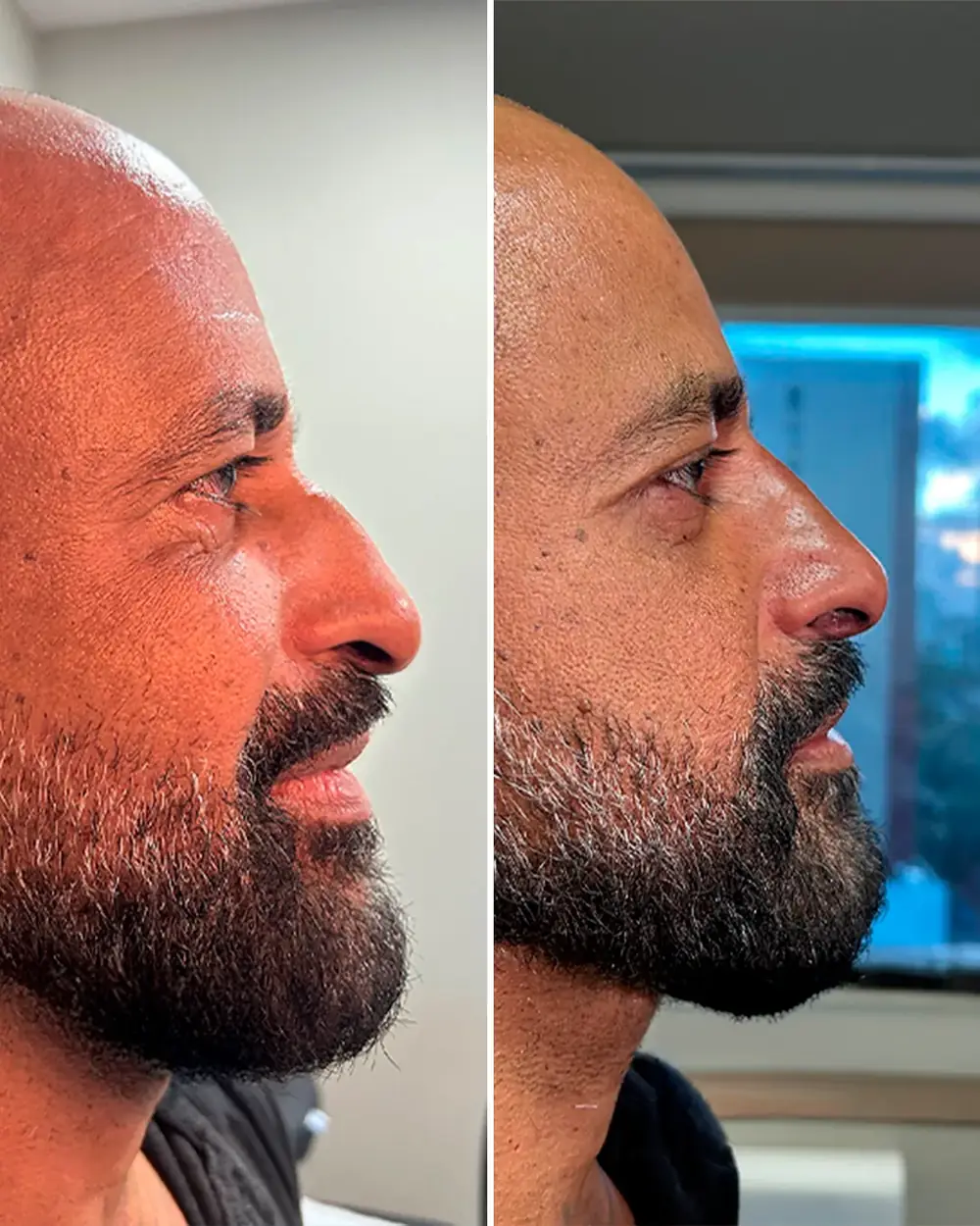 Antes e depois de rinomodelação sem cirurgia com o Dr. Flávio Werneque