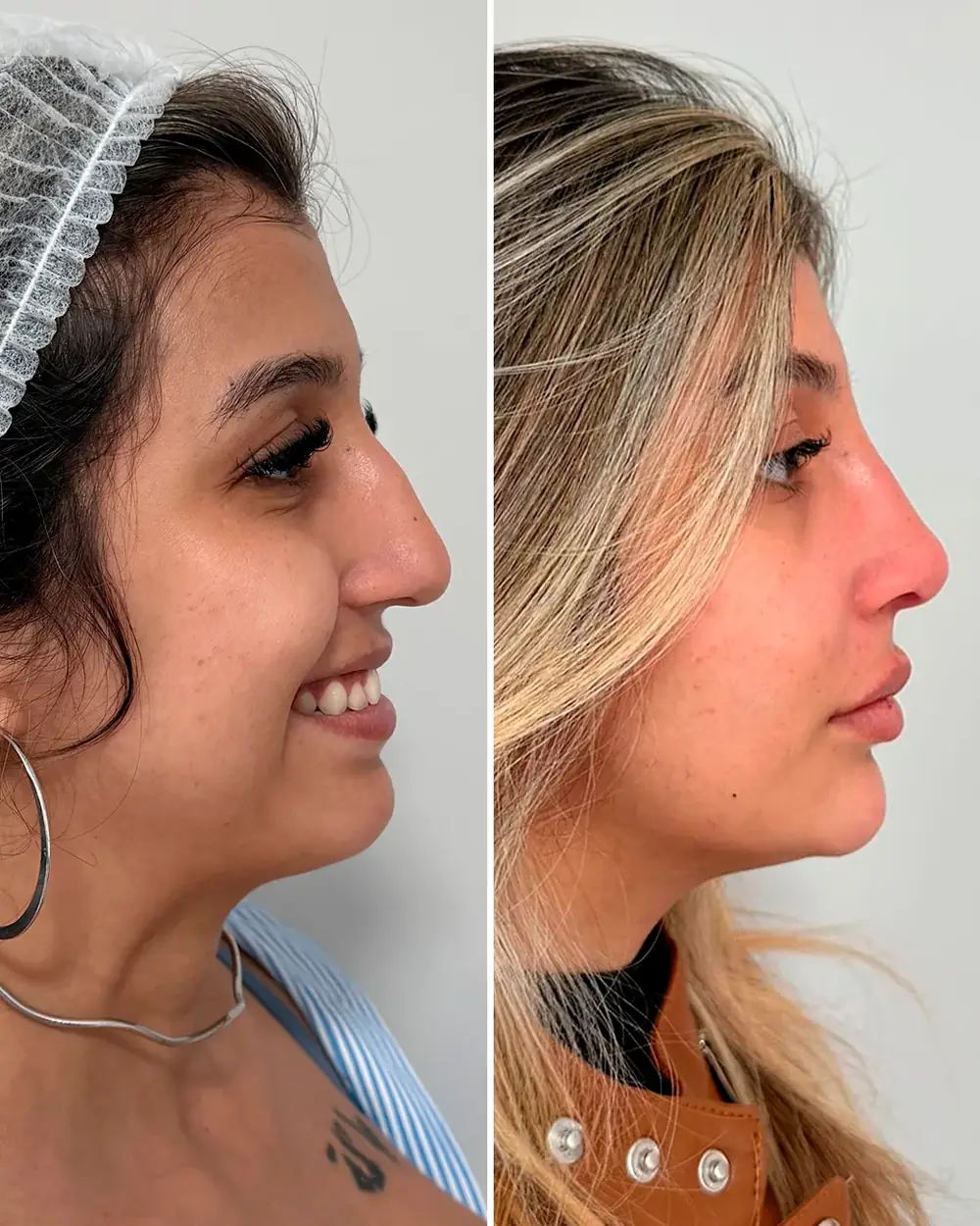 Antes e depois: Rinomodelação sem cirurgia